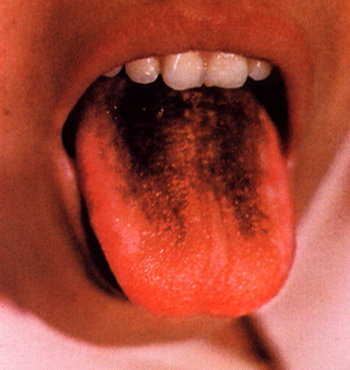 língua lateral preta